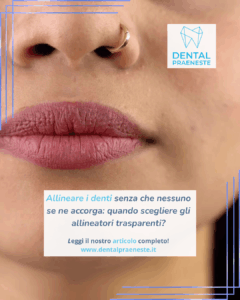 Bocca femminile in attesa di applicazione di allineatori trasparenti